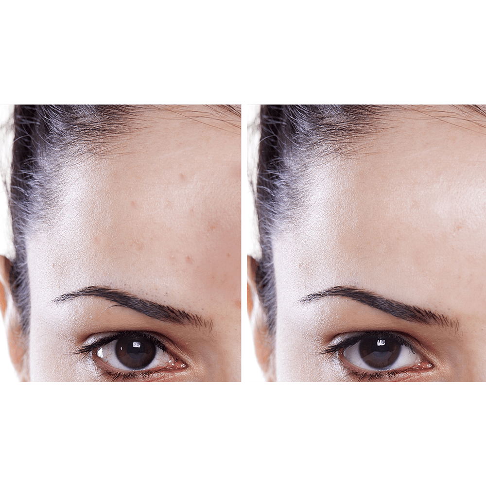 5-aqua-glo-hydradermabrasion-1