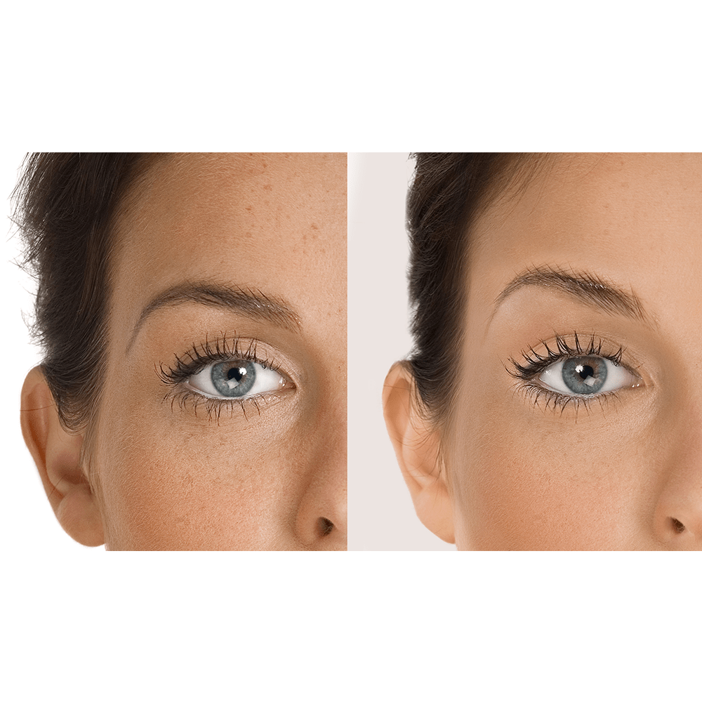 6-aqua-glo-hydradermabrasion-1-1